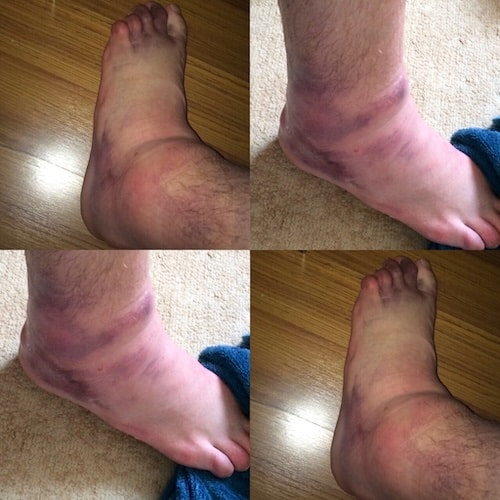 a picture of Adam Kemp's ankle injury in Astana in 2015